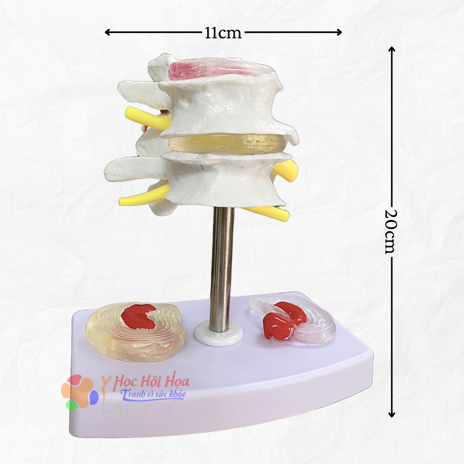 mo-hinh-benh-ly-xuong-cot-song (1)