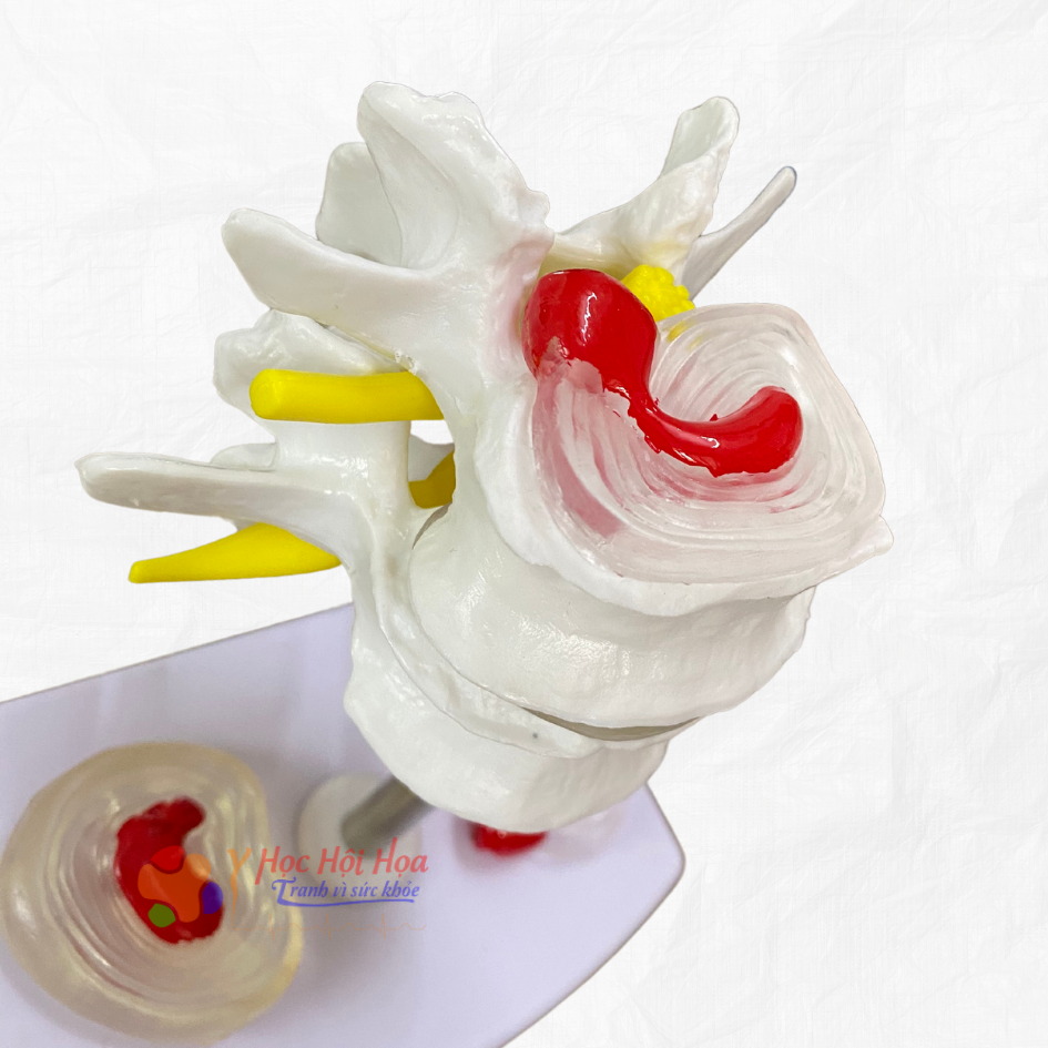 mo-hinh-benh-ly-xuong-cot-song (3)